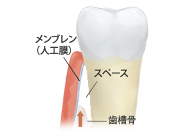 メンブレンを用いたGTR法のイメージ図